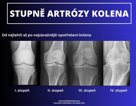 Artróza kolene neboli gonartróza