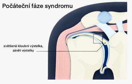 Pozdější fíze syndromu